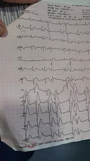 Understanding Precordial Leads in ECG Readings