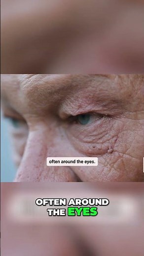 Xanthomas Explained: Causes, Symptoms & Treatment Options