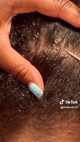 #foryou #dandruff #dandruffsolution | dandruff