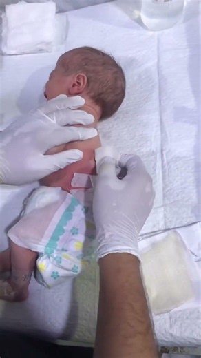 Changing dressing to MMC and hydrocephalus#NewbornCare# #BabyCare#USAParents