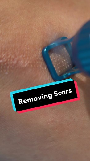 Ipixel Scar removal treatment helps resurface the area by burning off a layer of dead skin cells! The iPixel directs a short, intense burst of laser energy onto the surface of the skin. As a result, both water and skin tissue become vapourous within the surface layers. iPixel skin-resurfacing laser treatment helps to improve skin texture, tone and pore size, and reduces or removes the appearance of marks and blemishes. #surgeryscars #scarremoval #scar #scars #exfoliating #deadskin #deadskinremov