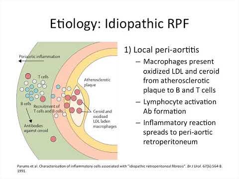Retroperitoneal Fibrosis