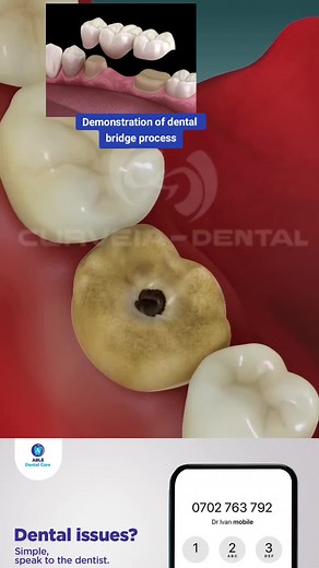 Demonstration of Dental Bridge Process