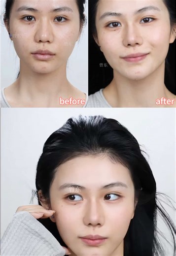 Understanding Facial Liposuction and Its Impact on Women