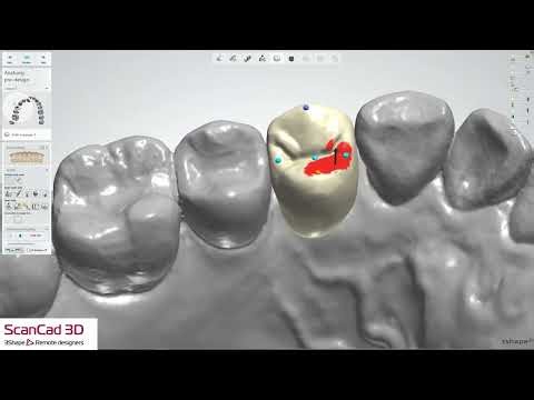 3shape abutment