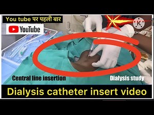 Dialysis Catheter insertion | hemodialysis catheter cathatization video | jugular catheter insert