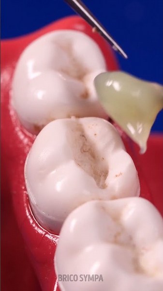 Incroyable restauration dentaire ! 🛠️🦷 Comment c'est réparé
