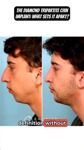 Custom Diamond Tripartite Chin Implants Explained
