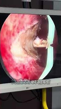 Hysteroscopic Metreplasty