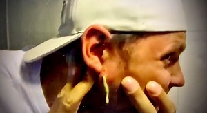 Best blackhead videos on Instagram: "Huge zit on cheek and endless puss #zit #pimple #pimplepopping #drpimplepopper #pimples #pimplepopper #blackheadremoval #blackheads #whiteheadremoval #sivilcetedavisi #sivilcesıkma #sivilce #sivilcevideosu"