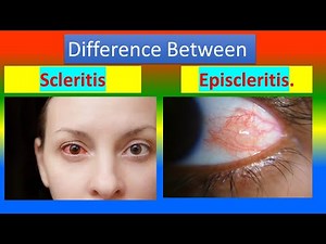 Difference between Scleritis and Episcleritis