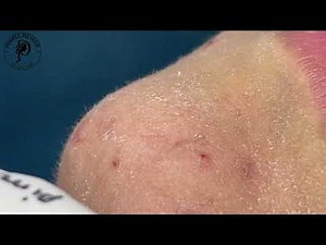Super Deep Nose Blackhead Extraction | Oddly Satisfying Treatment 4 | Pimple Heaven