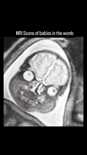 MRI scan of Fetus in the Womb #fblifestyle | Dr. Muhammed Ziya