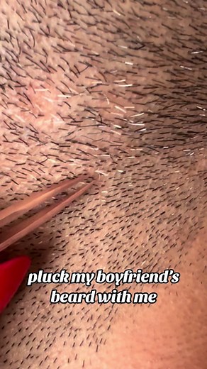 Satisfying Beard Plucking with Tweezers | Hair Follicle Removal