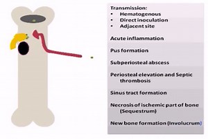 Pathophysiology of Osteomyelitis