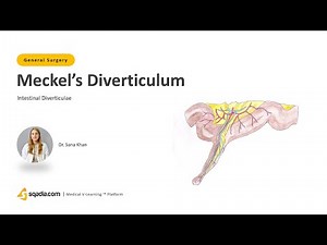 Intestinal Diverticulae | Meckels Diverticulum