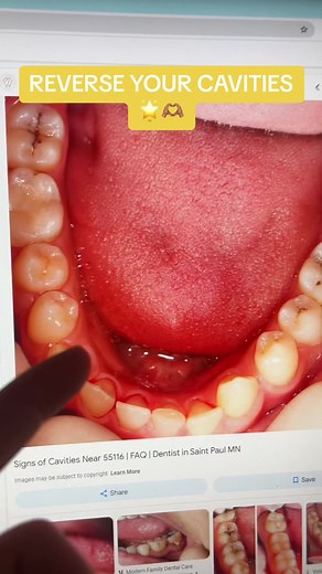 Reverse Cavities with Toothpaste Tablets - Oral Health Solution