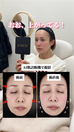 【カスタマイズヒアル】こめかみと頬の凹みを解消！ #美容皮膚科 #美容 #福岡ヒアルロン酸