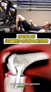 Así es la ruptura del Ligamento Cruzado Anterior C1rugia de reparación del LCA #reels #LCA #doctor #ligamentocruzadoanterior | Dr. Diego Hurtado