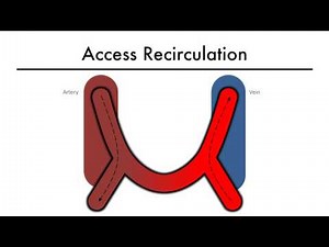Hemodialysis Kinetics 101 08 Access Recirculation