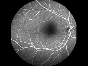 Fundus Fluorescein Angiographic Studies