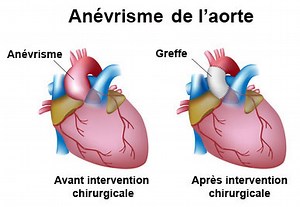 Anévrisme de l'aorte : symptômes, traitement, définition