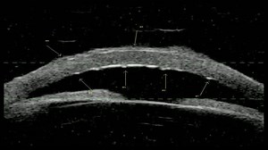 Image Acquisition and Exam Technique for Ultrasound Biomicroscopy with Quantel UBM Systems - Eyetube