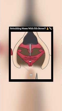 Rib Cartilage Rhinoplasty: How Doctors ACTUALLY Make Noses Sharper! 👃 ​#PlasticSurgery