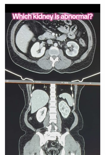 Understanding Asymmetrical Renal Enhancement in Radiology