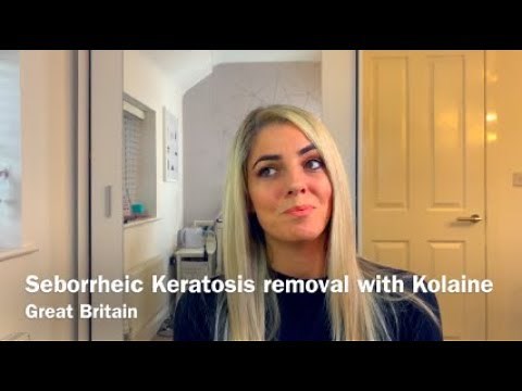 Seborrheic keratosis removal With Kolaine