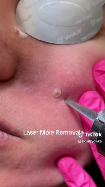Understanding Dermal Nevi and Laser Mole Removal