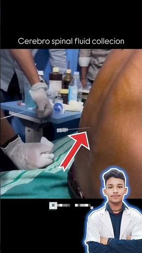 CSF Collection
