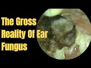 The Gross Reality Of Ear Fungus