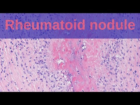 What are Rheumatoid Nodules? - Pathology mini tutorials