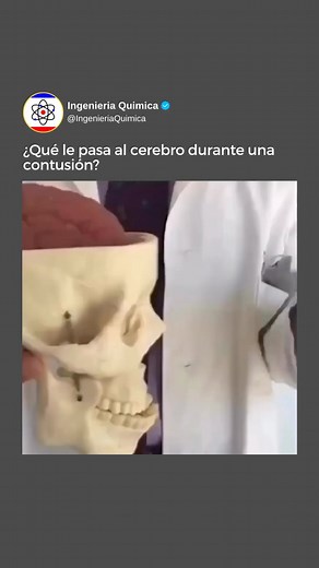 😔🧠 Cuando ocurre una contusión cerebral, el cerebro sufre una lesión traumática. Puede ser causada por un golpe directo en la cabeza o por un movimiento violento que sacude el cerebro dentro del cráneo. Esto provoca una serie de cambios en el tejido cerebral. 💥🩸 En primer lugar, se produce una lesión física en los tejidos del cerebro, lo que puede dar lugar a la rotura de vasos sanguíneos y la formación de hematomas. Estos hematomas pueden comprimir el tejido cerebral circundante y causar un