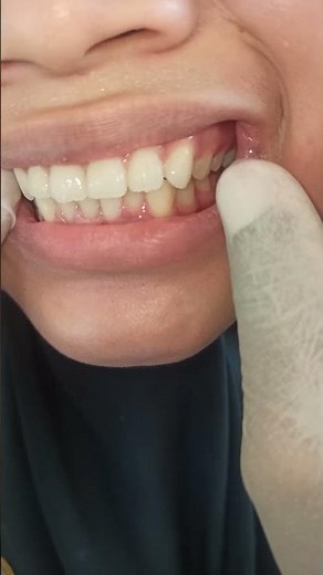 Molar Polyps in School Children Should Not Be Underestimated