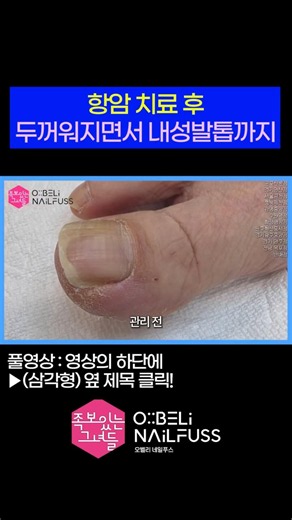 항암치료 후 두꺼워지면서 내성발톱까지 😍 #내성발톱 #toenails #ingrown_toenail #발톱무좀 #무좀 #무좀발톱 #족보있는그녀들