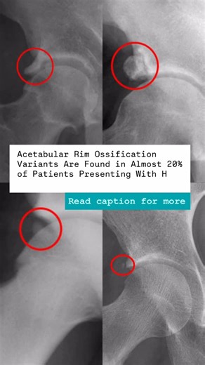 Mehmet Gem | Specialist Hip Physio on Instagram: "Ossified labrum on an AP pelvis X-ray. Often labelled as an osteophyte or dismissed as “early arthritis”, but it’s not always either. Periacetabular calcifications are actually common, seen in around 1 in 5 hips on plain radiographs. The key issue is that they are not one single entity. Different patterns exist. Small labral calcifications. Os acetabuli. Acetabular rim stress fractures. And complete or partial ossification of the labrum. Labral o