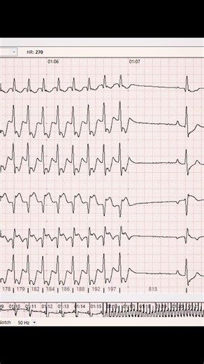 Pet Cardiology 💚 Dr.Carmen Vodă | 🐶⚡ Supraventricular Tachycardia (SVT) in dogs - think mechanism, not just “fast HR” SVT types 📚 • 🔁 Reentrant (most common “paroxysmal... | Instagram