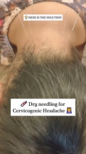 🧠 Cervicogenic Headache (CGH): What You Need to Know ⠀ Not all headaches come from the head! If your headache often starts at the base of your skull or neck and radiates forward, you're possibly dealing with a Cervicogenic Headache — a type of headache that originates from dysfunction in the neck (cervical spine). 💉 Dry Needling for CGH Relief Dry needling is a highly effective technique used by physiotherapists to treat myofascial trigger points — hyper-irritable knots within a muscle. ⠀ ✅ Ho