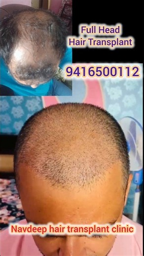 Full Head Hair Transplant Results After 10 Days | Single Session Transformation 💇‍♂️✨