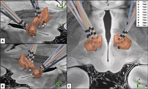 Responsive deep brain stimulation for the treatment of Tourette syndrome »  Department of Neurology » College of Medicine » University of Florida