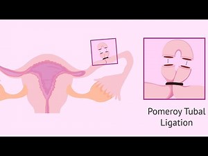 Pomeroy Sterilization for females Contraception; loop of each fallopian tube is tied off