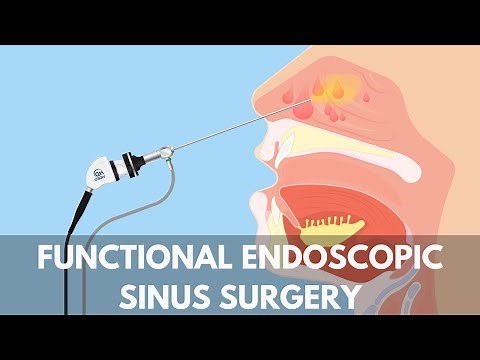 Functional Endoscopic Sinus Surgery Capital ENT