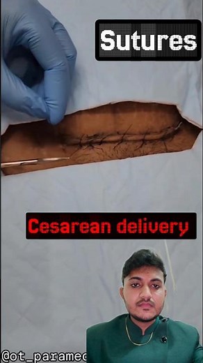 Cesarean dressing #cesareanbirth #sutures #dressing