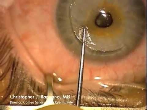 Surgical Removal of Epithelial Ingrowth after LASIK Surgery