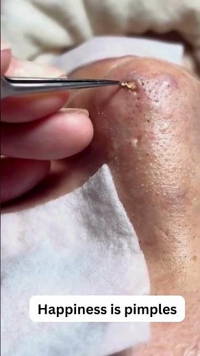 big blackheads 😯, super satisfied 🤩