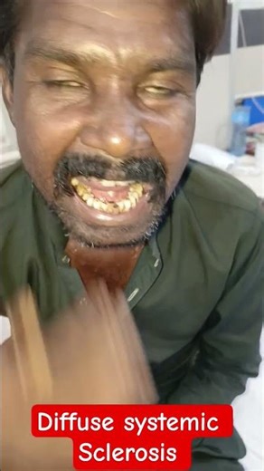 Diffuse Systemic Sclerosis #sclerosis #scleroderma #raynauds #sjogrenssyndrome #rheumatoidarthritis