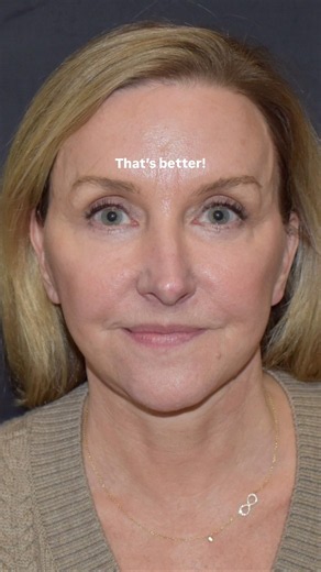 Deep Plane Facelift Before & After #FacialPlasticSurgeryofAustin #DrYulaIndeyeva