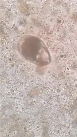 50K views · 575 reactions | Stool sample  #MedicalLabTechnician #lablife #diagnosis | Lab life | Facebook